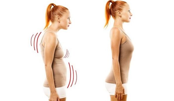 suora selkä ja huono asento kohdunkaulan osteokondroosin kanssa